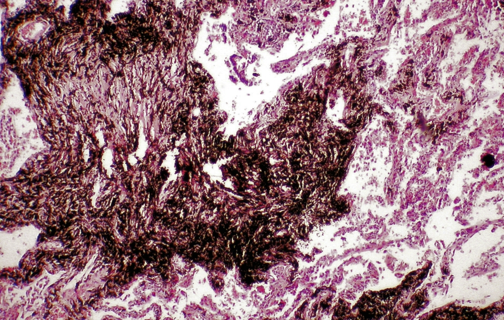 bergarbeiter-bronchitis-kohlenstaub